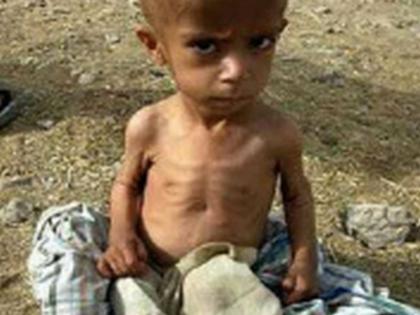 3 malnourished children in the district | जिल्ह्यात ३५१ कुपोषित बालके 3 malnourished children in the district | जिल्ह्यात ३५१ कुपोषित बालके