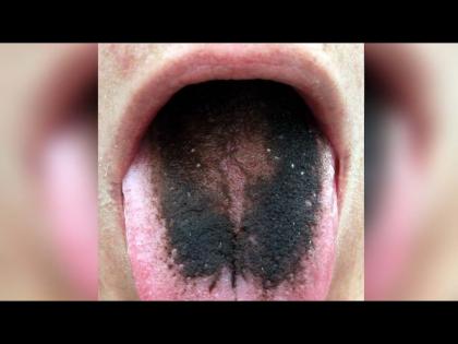 Woman tongue turns black reaction antibiotics black hairy tongue syndrome | अचानक काळी झाली महिलेची जीभ अन् उगवले केस, स्थिती पाहून डॉक्टर हैराण....