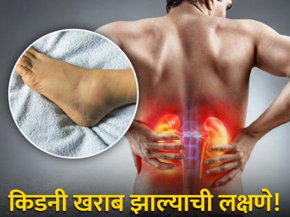 kidney problem symptoms in marathi | 'या' 7 संकेतांवरून ओळखा किडनीमध्ये आहे समस्या, वेळीच व्हाल सावध तर वाचेल जीव!