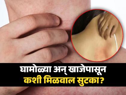 Home remedies for body itching and prickly heat in summer | उन्हाळ्यात त्वचेवर येणारी खाज आणि घामोळ्या दूर करण्याचे घरगुती उपाय!