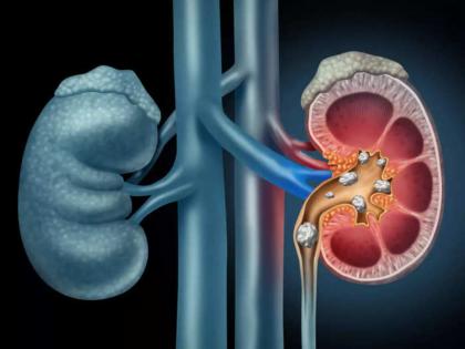 Tips that can flush out kidney stones without medicine | किडनी स्टोनपासून सुटका मिळवण्याचे घरगुती उपाय, एकदा कराच!