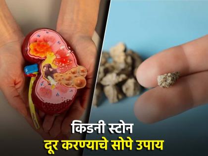 Effective methods to dissolve kidney stone without medicine or operation | मोठ्यातला मोठा किडनी स्टोन बाहेर काढण्याचे सोपे उपाय, लगेच मिळेल आराम!