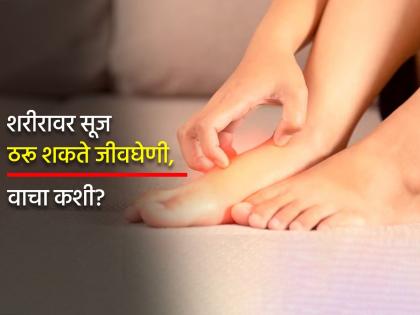 Health Tips : Swelling body may prove dangerous risk diabetes, heart disease, obesity increases | शरीरावर सूज असू शकते या गंभीर आजारांचा संकेत, दुर्लक्ष कराल तर होईल पश्चाताप!