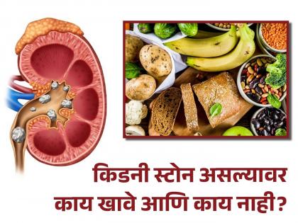 What to eat or not in kidney stone? you should know | किडनी स्टोन असल्यावर काय खावे-प्यावे किंवा काय खाणं टाळावे?