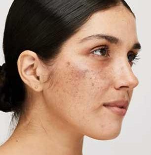 फक्त १० रुपये खर्च आणि चेहऱ्यावरचे काळे डाग-पिगमेंटेशन गायब, साइड इफेक्ट नसणारा १ सोपा उपाय