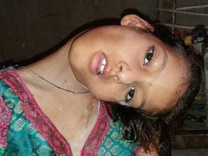 Oh dear! The girl's neck turns 180 degrees due to a strange disease | अरे बापरे! विचित्र आजारामुळे 180 डिग्रीमध्ये वळते या मुलीची मान  