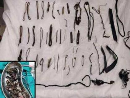 safety pins hair pins copper rings and many doctors find out from a woman stomach in ahmedabad | लोखंडाचे खिळे, पिन, चेन अन् बांगड्या; महिलेच्या पोटातून काढलं दीड किलोचं भंगार