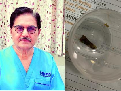 Removed the cloves stuck in the lungs for seven years |  सात वर्षांपासून फुप्फुसात अडकलेली लवंग बाहेर काढली