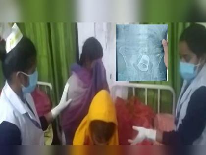 The husband had gone to his in-law's home to meet his wife, but when he returned, he started having stomach pain; Doctor surprised by X-Ray | पत्नीला भेटण्यासाठी सासुरवाडीला गेला होता पती, परतला तर सुरू झाली पोटदुखी; X-Ray पाहून डॉक्टर थक्क!