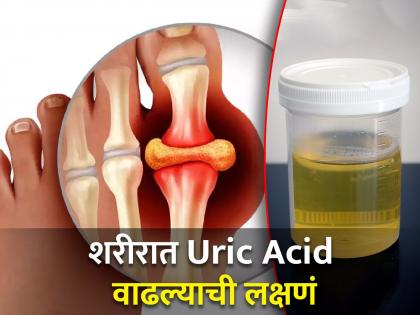 5 symptoms of high uric acid level you can see in urine know best ways to reduce uric acid levels | ही 5 लक्षण सांगतात शरीरात वाढलं आहे Uric Acid, जाणून घ्या हे दूर करण्याचे उपाय