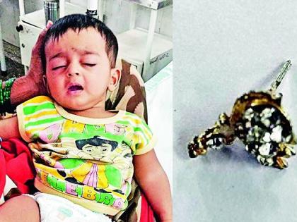 Seven-month-old baby swallows mother's earring; The doctor made a condition of his efforts | बापरे! सात महिन्यांच्या चिमुकल्याने गिळली आईच्या कानातली इअररिंग; डॉक्टरांनी केली प्रयत्नांची शर्थ