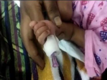Shocking! The nurse cut off the baby's finger while talking on the phone while trying to cut the bandage | धक्कादायक! कापायची होती पट्टी, फोनवर बोलण्याच्या नादात नर्सने कापले बाळाचे बोट Shocking! The nurse cut off the baby's finger while talking on the phone while trying to cut the bandage | धक्कादायक! कापायची होती पट्टी, फोनवर बोलण्याच्या नादात नर्सने कापले बाळाचे बोट