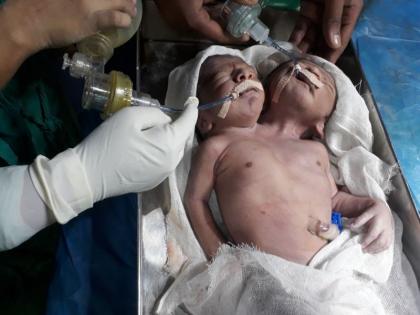 two headed baby born in beed | बीड : अंबाजोगाई वैद्यकीय महाविद्यालयाच्या प्रसूतीगृहात दोन तोंडाच्या बाळाचा जन्म, डॉ. संजय बनसोडेंनी केली यशस्वी शस्त्रक्रिया