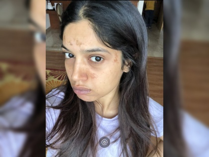 Bhumi pednekar shoots despite severe blisters on her face! | अशा अवस्थेत ही भूमीने थांबवले नाही 'सांड की आँख'चे शूटिंग, वाचून तुम्हीही म्हणाला शब्बास!