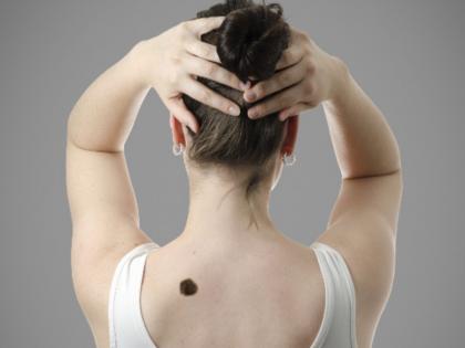 Find out which part of the body the birthmark is beneficial on! | शरीराच्या कोणत्या भागावर असलेली जन्मखूण लाभदायक ठरते, ते जाणून घ्या!