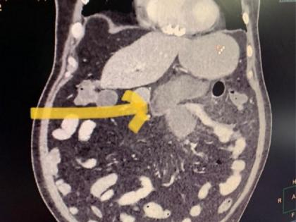 rare cases of mucormycosis black fungs of small intestine seen at sir ganga ram hospital | Mucormycosis : दिल्लीतील दोन रुग्णांमध्ये ब्लॅक फंगसचा दुर्मीळ संसर्ग, चिंता वाढली