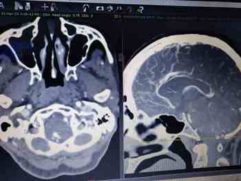 Successful surgery on rare brain disease: Woman gets life donation | मेंदूच्या दुर्मिळ आजारावर यशस्वी शस्त्रक्रिया : महिलेला मिळाले जीवनदान