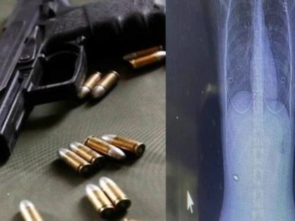 bullet stuck in woman's back for fifteen years without any pain | १५ वर्ष पाठीत गोळी अडकलेली पण महिलेला कोणत्याच वेदना होत नव्हत्या, साधी जाणीवही नव्हती