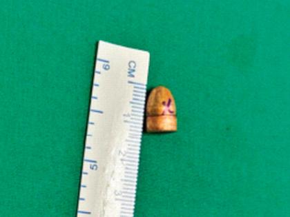 डोक्यात अडकलेली गोळी काढून वाचविला जीव; जे. जे. रुग्णालयात यशस्वी शस्त्रक्रिया; प्रकृती स्थिर  - Marathi News | Life saved by removing bullet stuck in head; Successful surgery at J. J. Hospital; Condition stable | Latest News at Lokmat.com