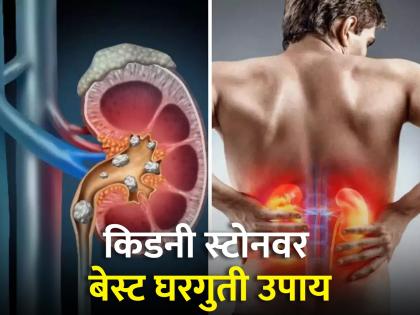 Kidney Stone Remedies : 4 ways to remove kidney stones at home | किडनी स्टोन दूर करण्यासाठी बेस्ट आहेत 'हे' घरगुती उपाय, लगेच मिळेल आराम!