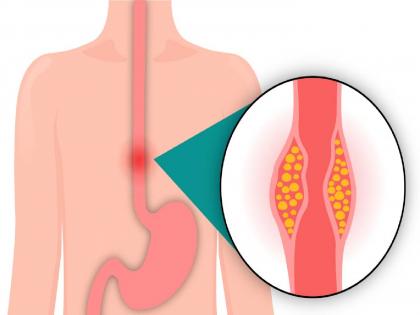 What causes esophageal cancer to grow? What are the symptoms? | अन्ननलिकेचा कॅन्सर कशामुळे वाढतोय? लक्षणे काय?