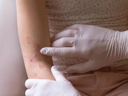 Already with fever, there is trouble with rash! | आधीच तापाची साथ त्यात पुरळचा त्रास ! डॉक्टरांचा सल्ला घ्या 