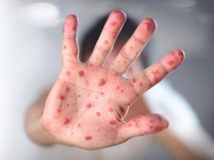 Measles is a big challenge before the administration, the death of an 8-month-old girl in Bhinwandi | प्रशासनापुढे गोवरचं मोठं आव्हान, भिवंडीत 8 महिन्यांच्या चिमुरडीचा मृत्यू