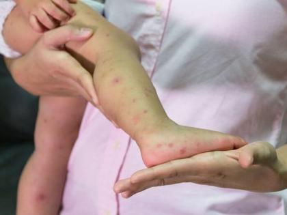 Another death from measles in Mumbai, 1 year child die in kasturba hospital | मुंबईत गोवरची साथ, १ वर्षाच्या बाळाचा मृत्यू; मृतांचा आकडा ४ वर