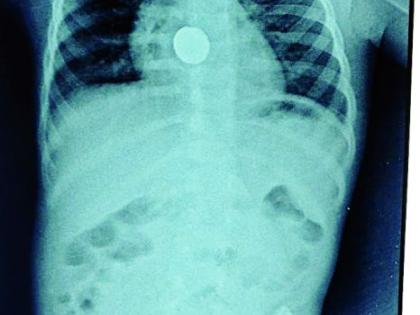 Four-year-old son swallowed cell, a successful operation in the super | चार वर्षीय मुलाने गिळला सेल : ‘सुपर’मध्ये झाली यशस्वी शस्त्रक्रिया