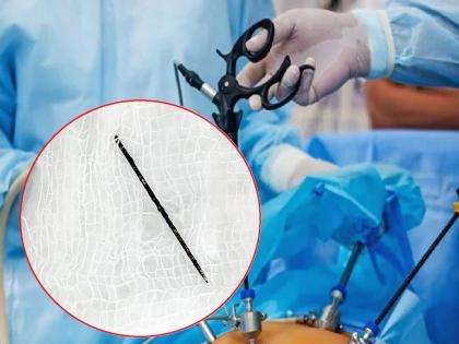 The surgery was for the testicles, but the doctor was shocked to find a needle in the toddler's thigh | शस्त्रक्रिया अंडकोशाची, पण चिमुकल्याच्या जांघेत सुई सापडल्याने डाॅक्टर थक्क