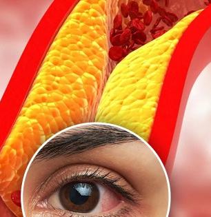 डोळ्यांमध्ये पिवळे-लाल ठिपके दिसतात, सूजही आहे? उठा आणि लगेच करा कोलेस्टेरॉलची टेस्ट