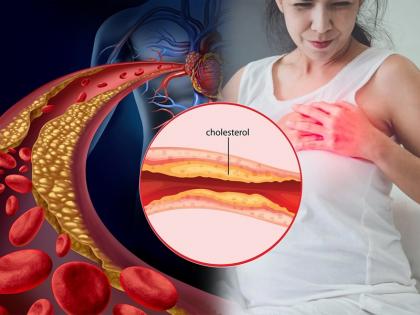 high cholesterol increases heart attack risk know how to reduce | चिंताजनक! कोलेस्ट्रॉल वाढलं तर कधीही येऊ शकतो हार्ट अटॅक; 'असं' करा कंट्रोल