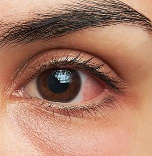 डोळे सांगतात कोलेस्टेरॉल वाढण्याची ५ लक्षणे! नियमित खा ' हे ' पदार्थ, हॉर्ट ॲटॅकचा धोका टाळा..