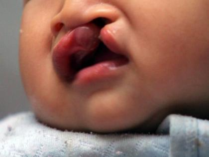 Congenital malformations in 25 percent of children; Diagnosis through free blood test | २५ टक्के बालकांमध्ये जन्मजात व्यंग; मोफत रक्ततपासणीतून निदान