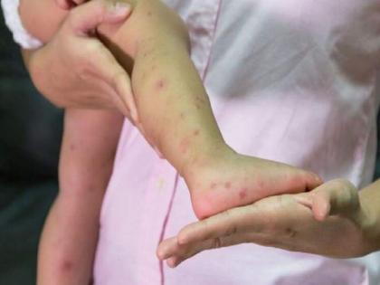 Measles patients under control number of patients stabilized in thane | गोवर रुग्ण आटोक्यात, रुग्ण संख्या स्थिरावली