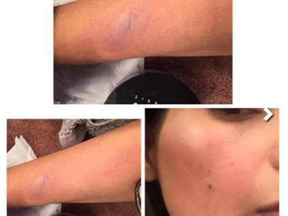 बिप्सच्या चेहर्‍यावर दाग-धब्बे !