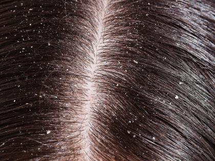 Are you troubled with the problem of Dandruff? | डॅँड्रफच्या समस्येने त्रस्त आहात?