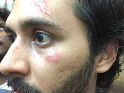 The actor, who was on 'Gachchi', had to make a serious accident, plastic surgery | 'गच्ची' वर झाला होता या अभिनेत्याचा गंभीर अपघात,करावी लागली प्लास्टिक सर्जरी