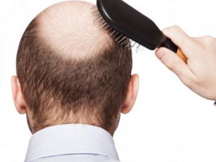 Health: Why is the problem of hair leakage in men at 20-30 years of age? | Health : ​का २०-३० वयातच पुरुषांना सतावते केस गळतीची समस्या?