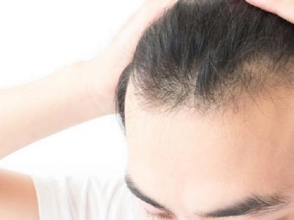 Beauty: 'This remedy will become bald, new case will come away!' | Beauty : ​‘या’ एका उपायाने टक्कल होईल दूर, येतील नवे केस !