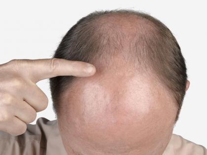 OMG: Headache baldness, 10 home remedies! | ​OMG : डोक्याला टक्कल पडलीय, करा १० घरगुती उपाय !