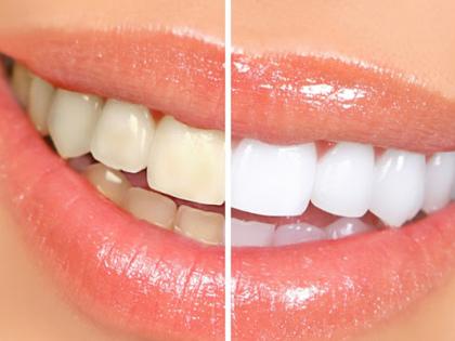 The teeth will shine in just three minutes | केवळ तीन मिनिटांत दात होतील चमकदार The teeth will shine in just three minutes | केवळ तीन मिनिटांत दात होतील चमकदार