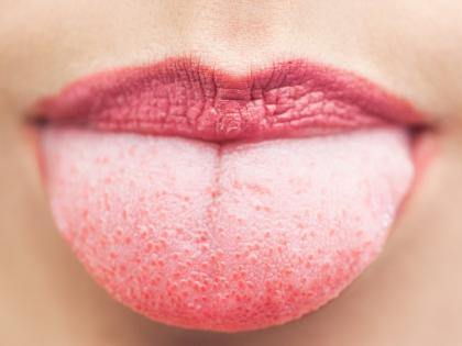 Do Home Remedies After Burning the Tongue | जीभ जळाल्यानंतर करा हे घरगुती उपचार Do Home Remedies After Burning the Tongue | जीभ जळाल्यानंतर करा हे घरगुती उपचार