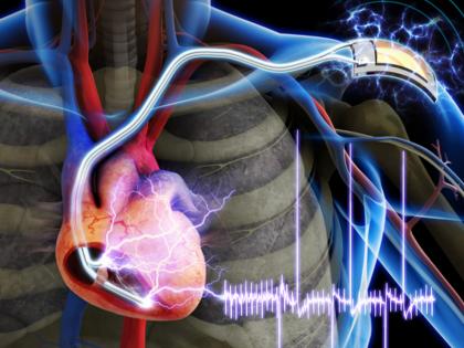 Pacemaker running on the power of the heart | हृदयाच्या पॉवरवर चालणार पेसमेकर