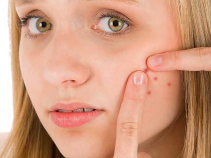 Pimples are due to this reason! | या कारणाने होतात पिंंपल्स ! Pimples are due to this reason! | या कारणाने होतात पिंंपल्स !