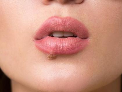 Cold sore and mouth ulcer symptoms and causes home remedies stages treatment prevention | तुम्हालाही कोल्ड सोर झालं आहे का? 'या' गोष्टी करतील मदत!