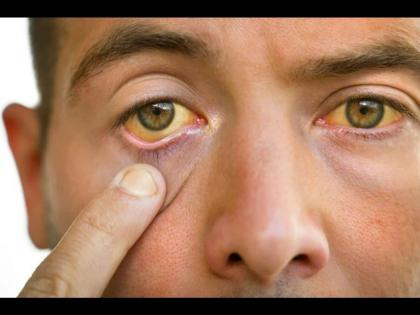 High cholesterol affects your eyes signs you should not ignore | High Cholesterol: हाय कोलेस्ट्रॉलमुळे जाऊ शकते डोळ्यांची दृष्टी, या संकेतांकडे करू नका दुर्लक्ष