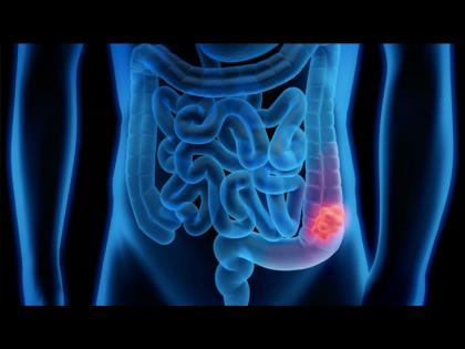 Colorectal cancer may block intestine and 6 signs that can see in bowel movements | आतड्या ब्लॉक करतो कोलोरेक्टल कॅन्सर, केवळ टॉयलेटमध्ये दिसतात हे 6 संकेत