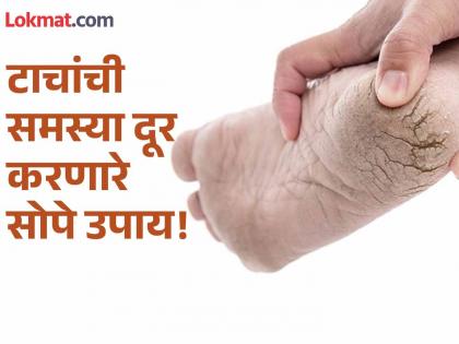 Home remedies for crack heel winter | हिवाळ्यात टाचांना पडलेल्या भेगांमुळे वैतागलात? लगेच करा 'हे' सोपे घरगुती उपाय!