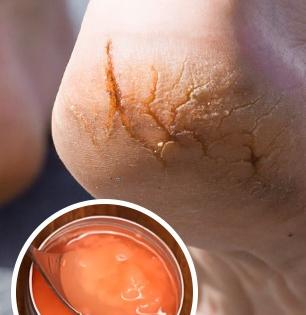 चमचाभर खोबरेल तेल, २ मेणबत्त्या वापरुन करा पायांच्या भेगांवर असरदार उपाय - भेगाळलेल्या टाचाही होतील मऊमुलायम...